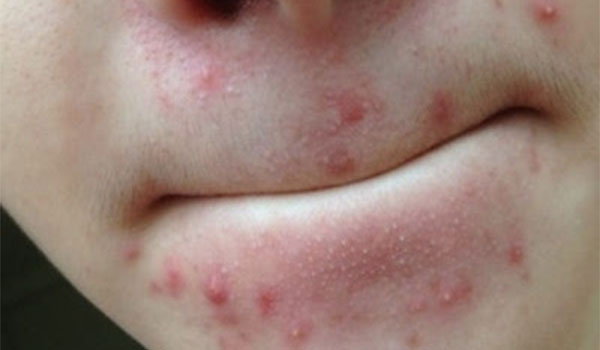 嘴巴周围长痘的原因 什么因素引起嘴巴周围长痘
