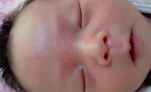 宝宝湿疹特征 宝宝脸上长湿疹怎么办