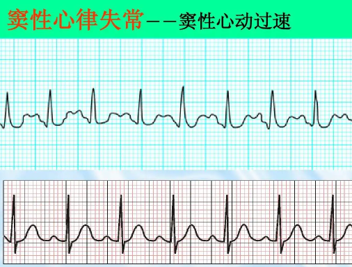 窦性心律不齐是心脏病早期吗3