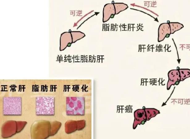 脂肪肝有什么危害 贫血肝脏肿大腹水下肢水肿