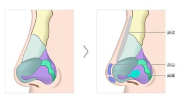 隆鼻-隆鼻取出假体后鼻子会变形吗 什么情况下需要取出假体