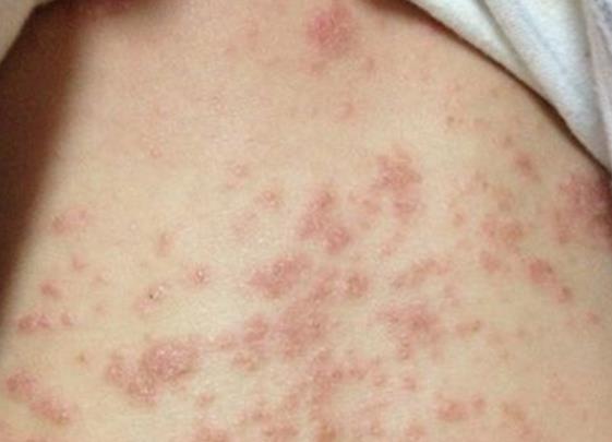 慢性湿疹初期图片