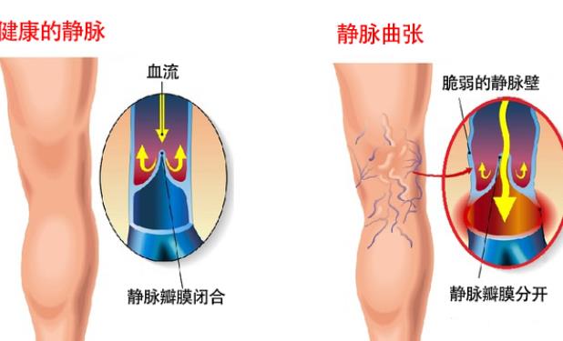 患静脉曲张如何垫高腿 在脚下垫垫子抬高15度到30度