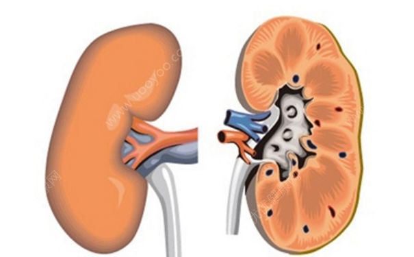 肾囊肿是肾囊事肾怎么回事？肾囊肿治疗方法(1)