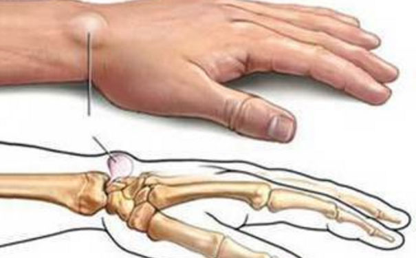 手腕起了一个鼓包怎么回事 手腕鼓包是什么原因