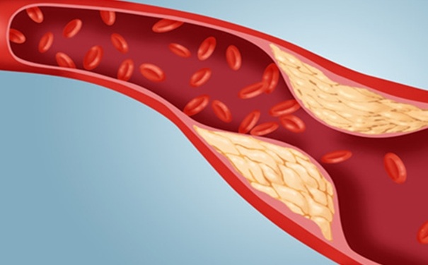动脉粥样硬化有哪些危害 动脉粥样硬化怎么调理