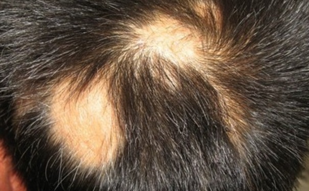 脱发有什么偏方治疗 治疗脱发的偏方