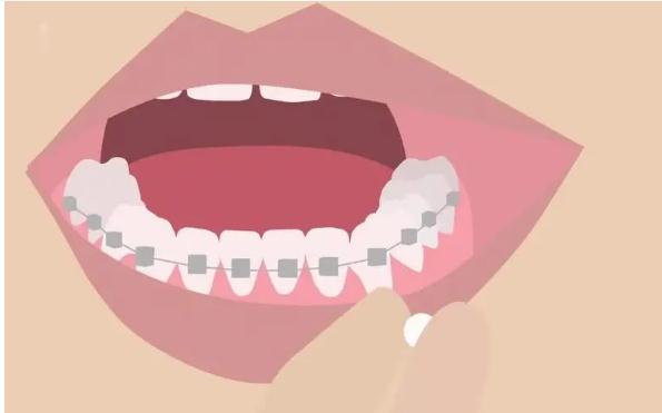 牙齿矫正有哪些禁忌人群 牙齿矫正后容易松动吗