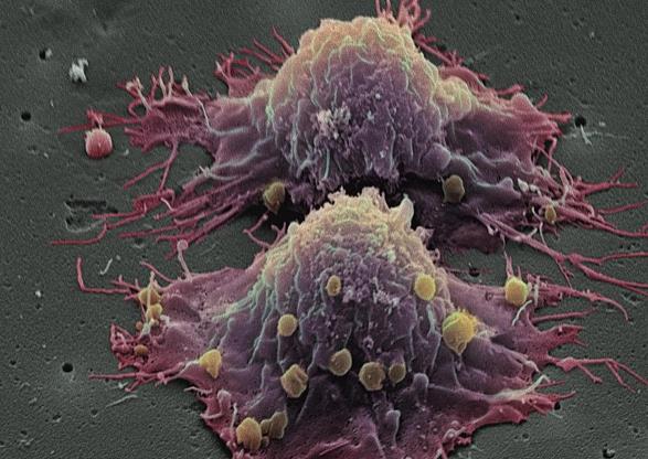 乳腺癌奈何医疗 乳腺癌的病因是什么