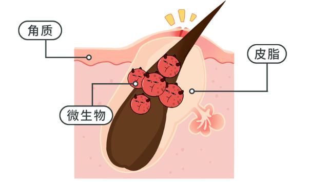 长痘痘的外因有哪些 脓包似的痘痘能手挤掉吗