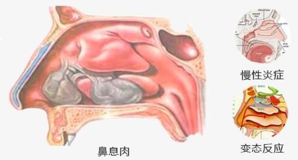 引起鼻息肉的原因有哪些 慢性感染感冒鼻塞饮食个人卫生等