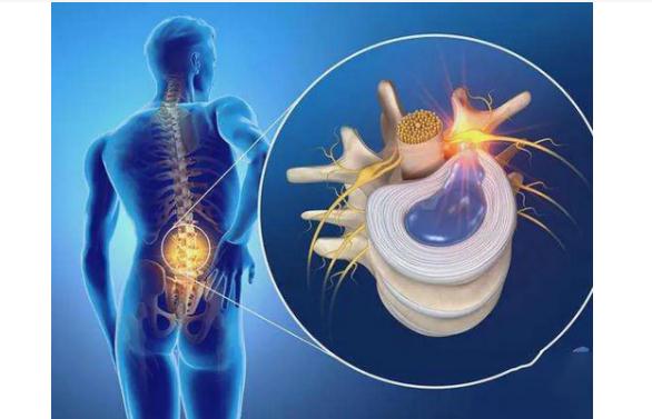 腰间盘突出的高发原因 腰间盘突出是什么原因引起的