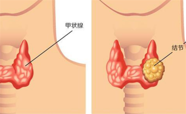 心情不好会增加甲状腺结节风险，心情差易患甲状腺结节吗