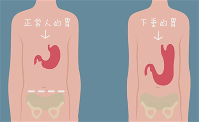 ​饭后运动会胃下垂吗