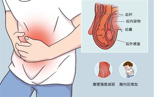 ​男人肚子大的5个原因，男人大肚子怎么形成的